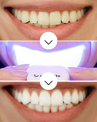 Smilebite Light & Bright Комплект за избелване на зъби LED лампа + Whitesmile Serum™ - 3